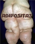 Adipositas - lipomatosis cordis